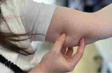  Procura por implante contraceptivo cresce 118% no SUS do Paraná em 2025